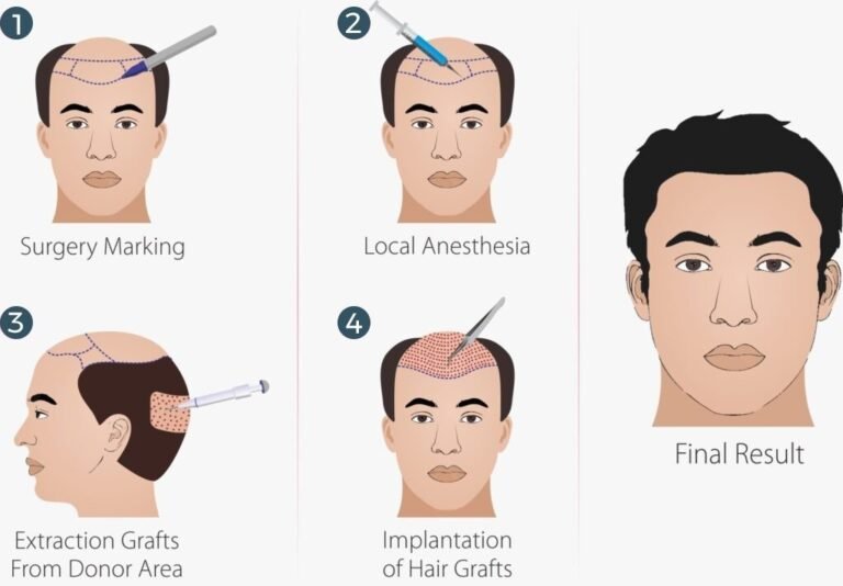 hair transplant process