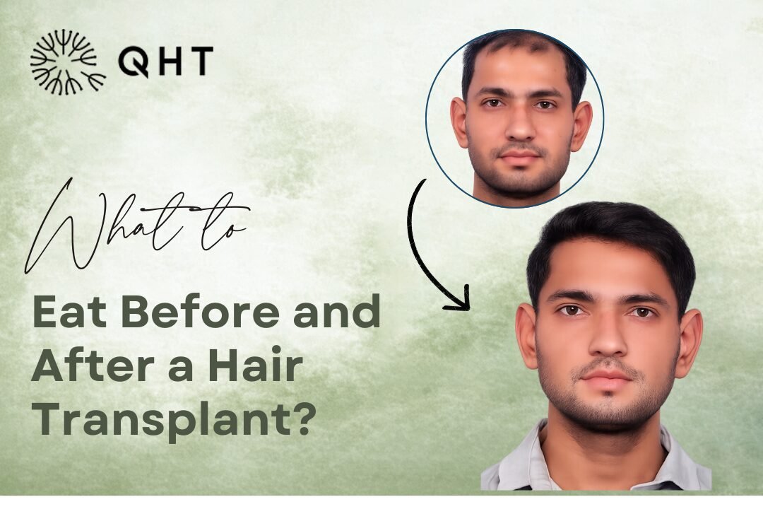 Diet Before & After Hair Transplant