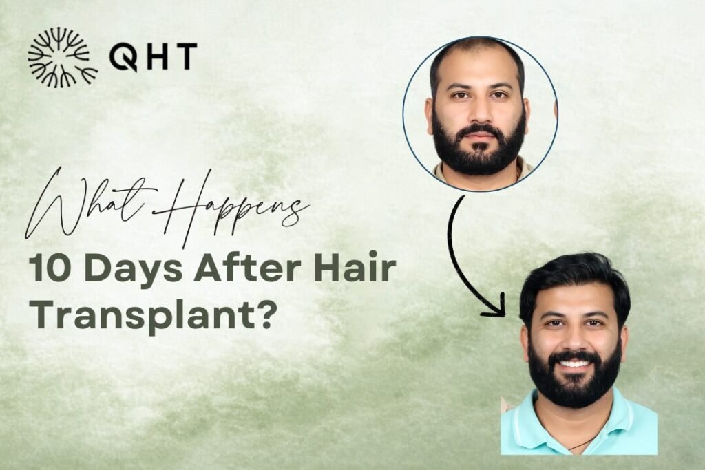 10 days after hair transplant