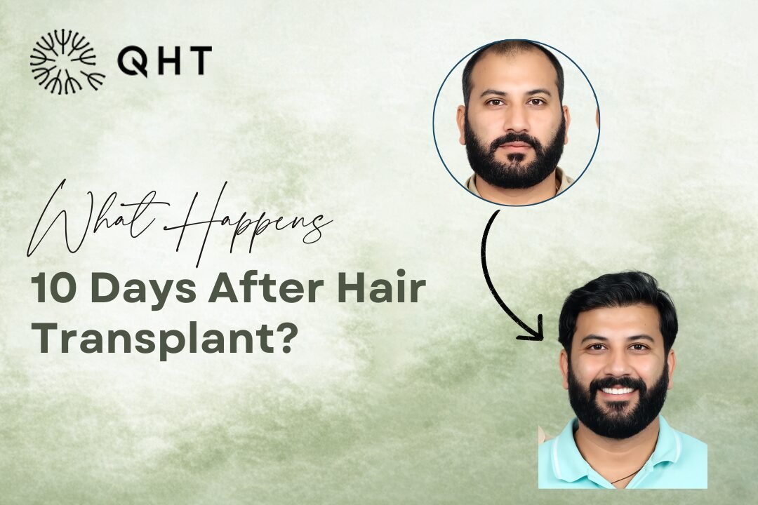 10 Days After Hair Transplant