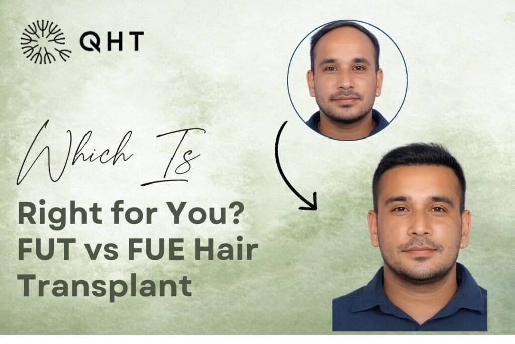 fue hair transplant cost