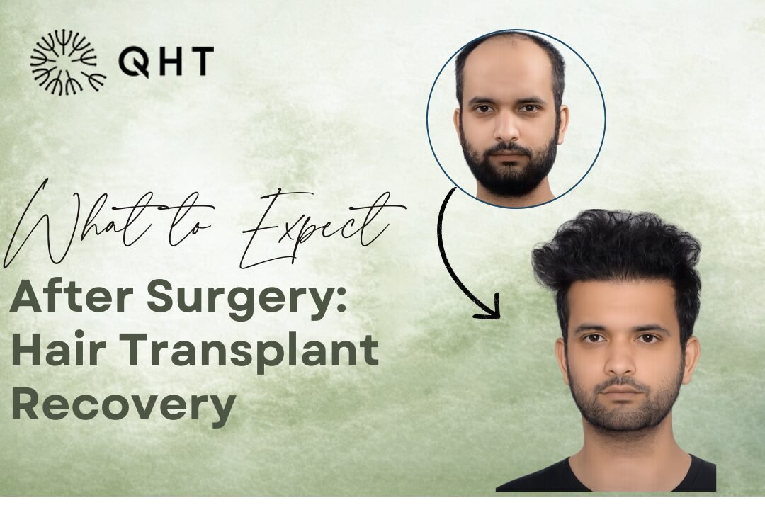 Recovery After Hair Transplant