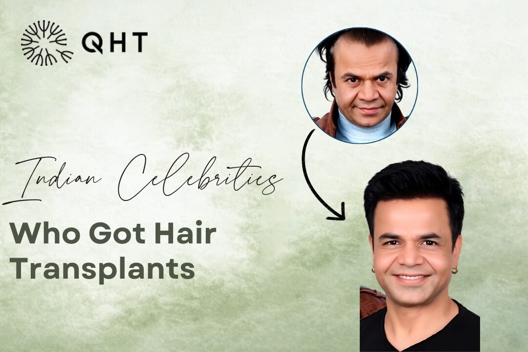 Celebrities Hair Transplant in India