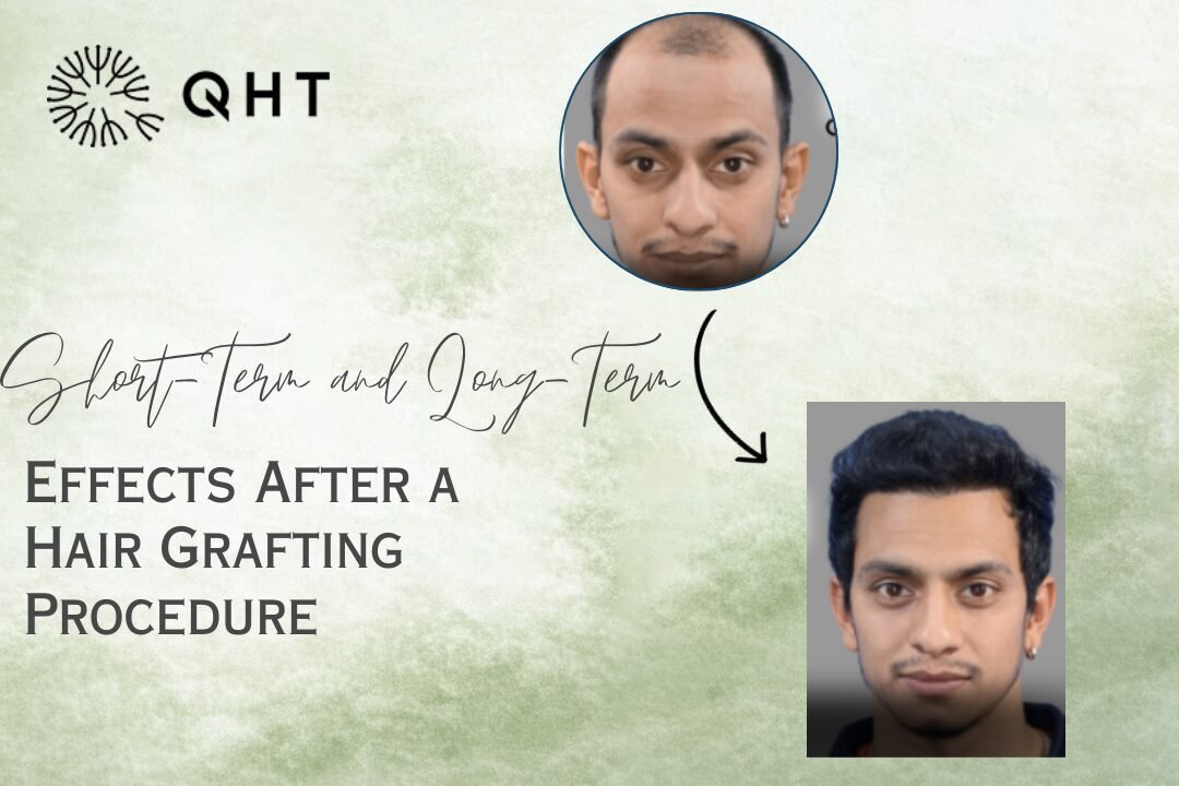 Hair Grafting: Short & Long-Term Effects