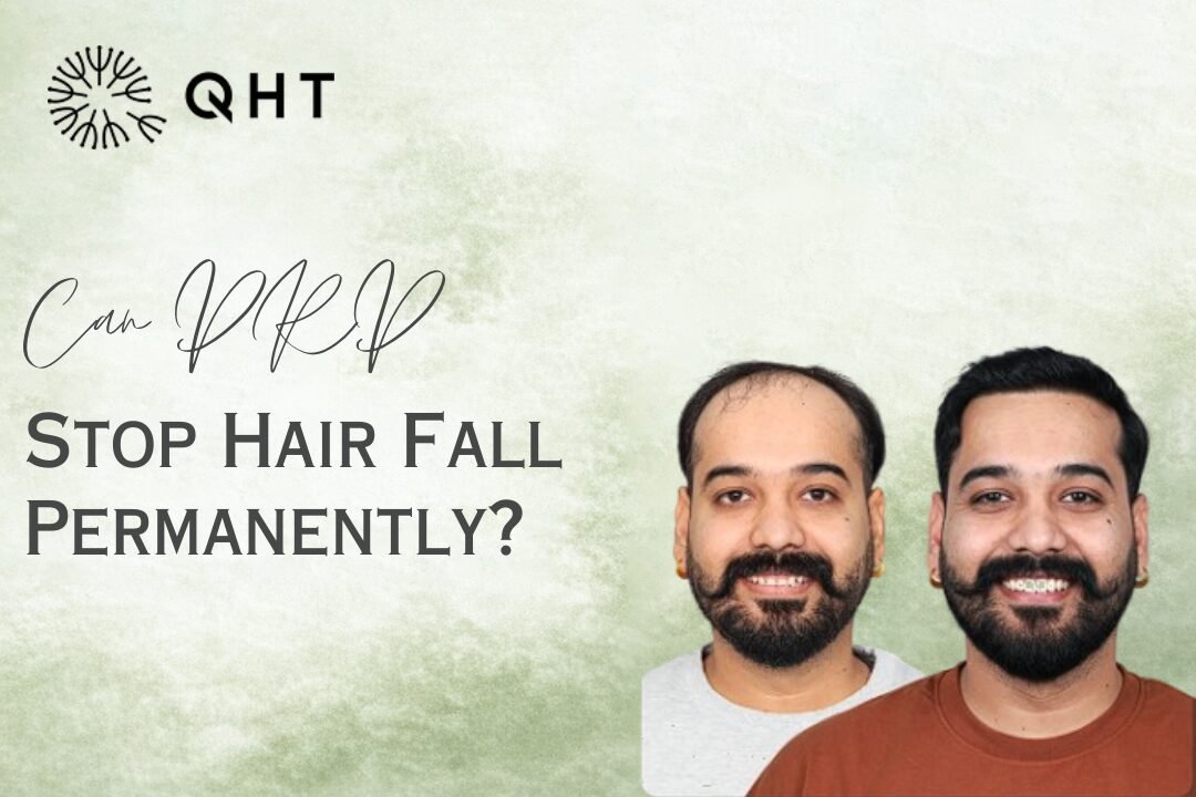 How PRP for Hair Fall Control Can Help Stop Hair Loss?
