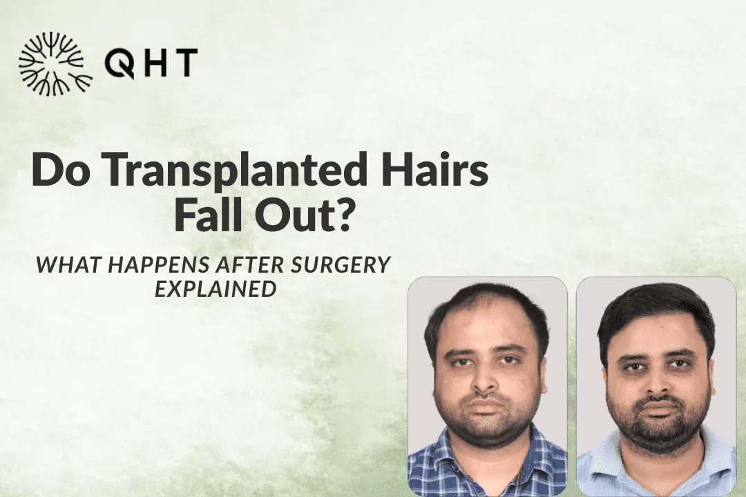 Do Transplanted Hairs Fall Out After Surgery? Full Explanation