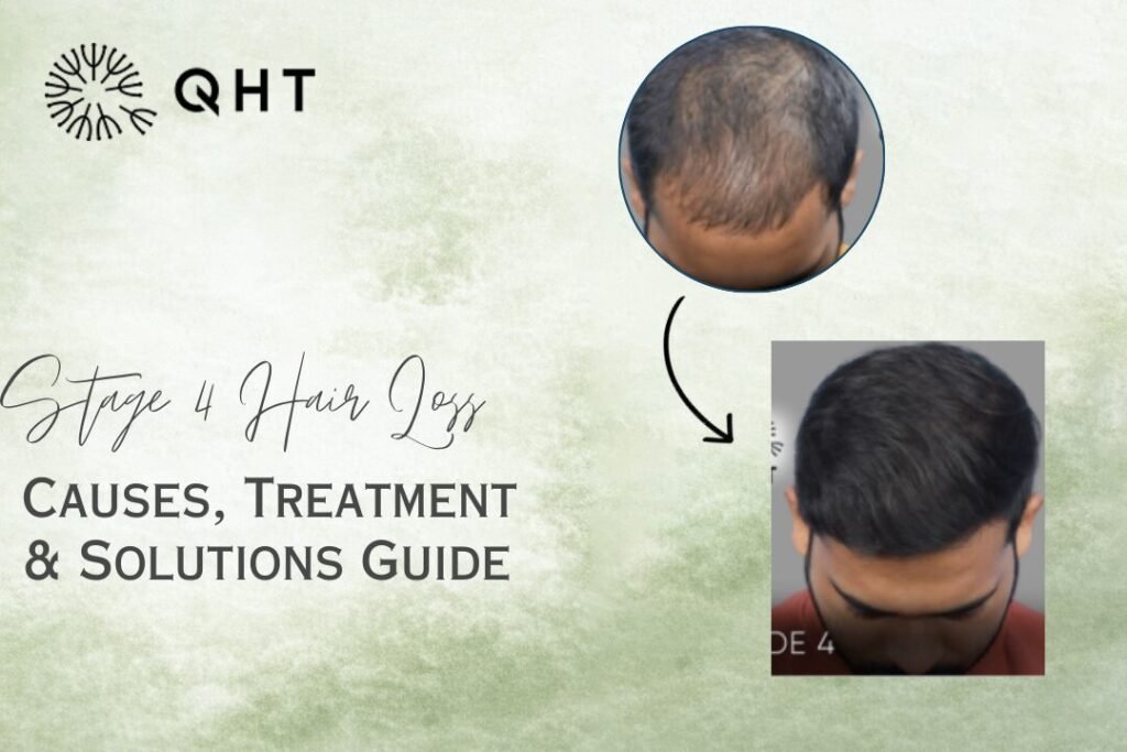 stage 4 hair loss
