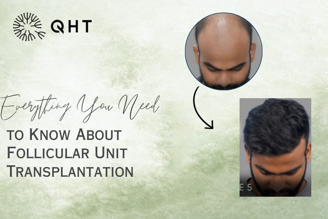 What Is FUT Hair Transplant? A Complete Guide