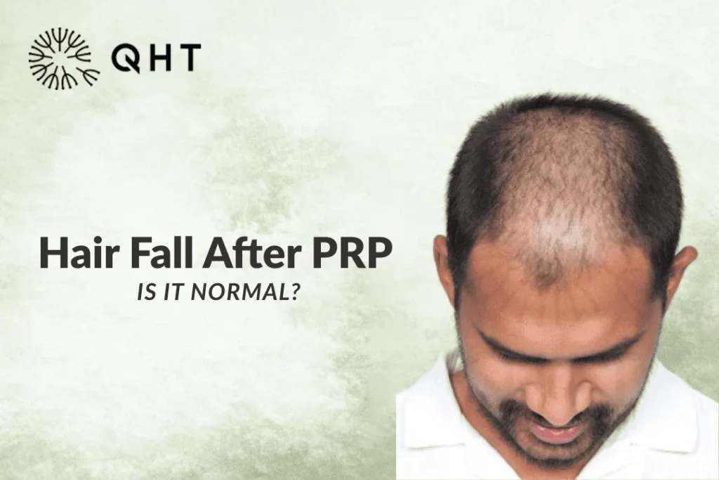 hair fall after PRP