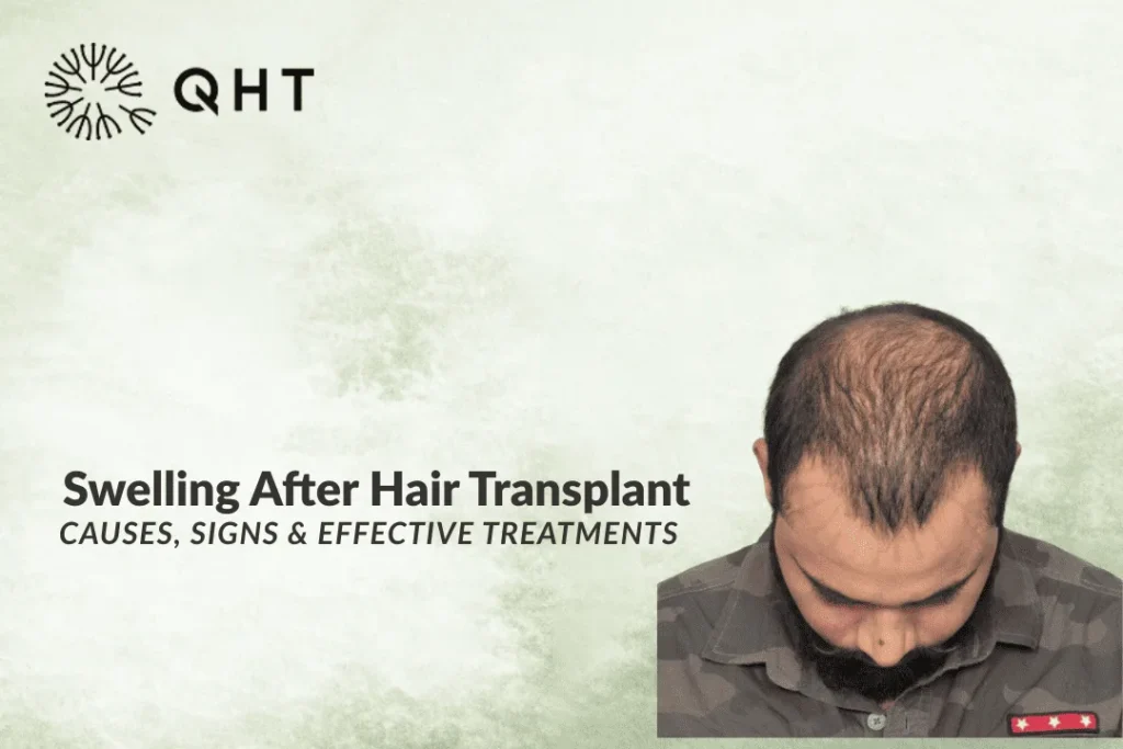 hair transplant swelling