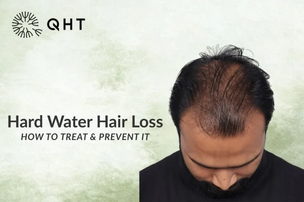 hard water hair loss solution
