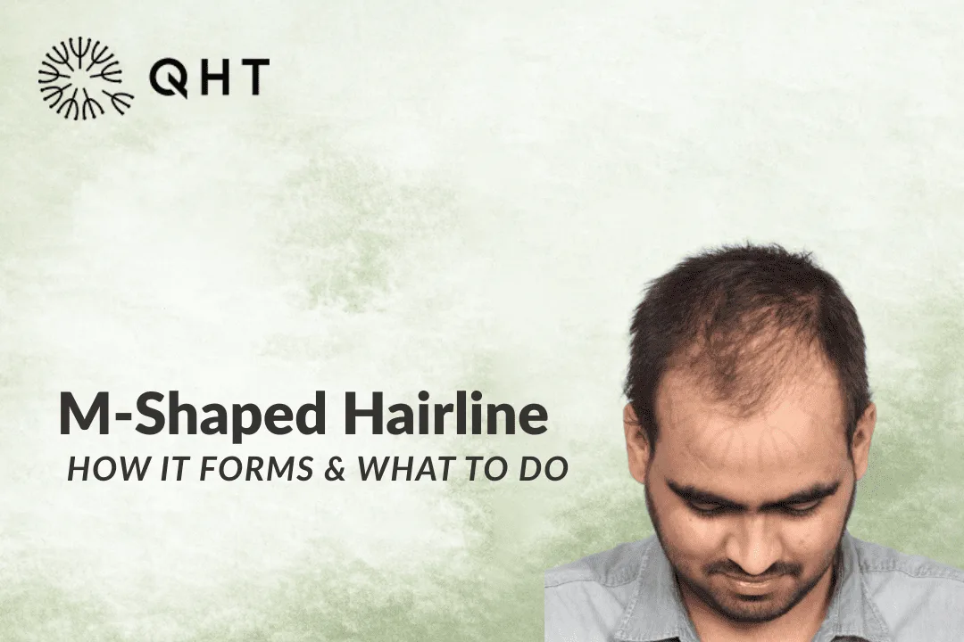 What is an M-shaped hairline?