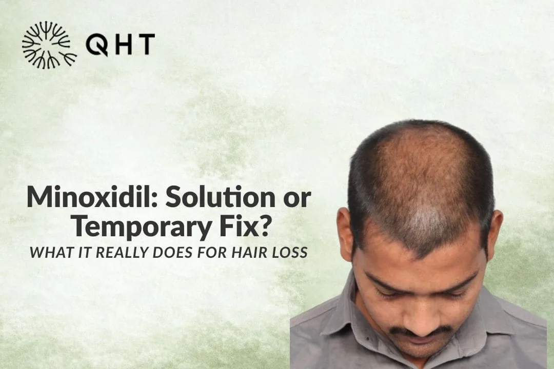 Is Minoxidil the Right Treatment for You or Just a Temporary Fix?