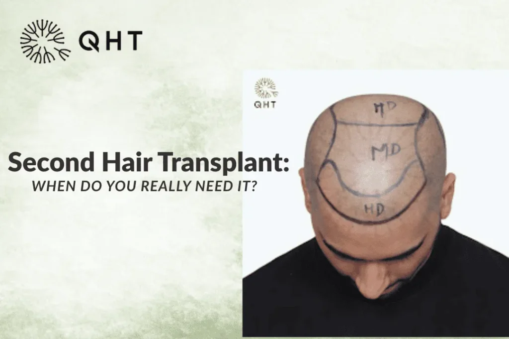 second hair transplant