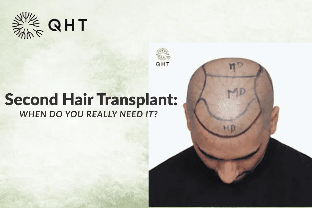 Second Hair Transplant: When Do You Really Need It?