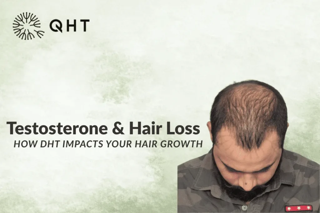 testosterone and DHT hair loss