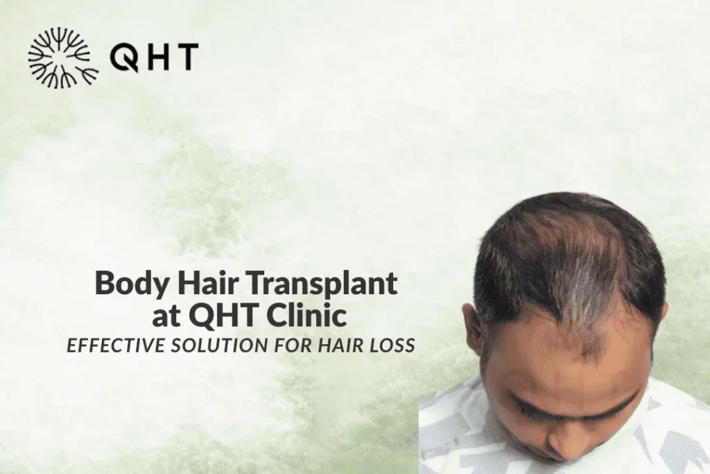 BHT hair transplant Gurgaon