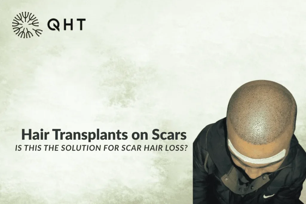 hair transplant on scars