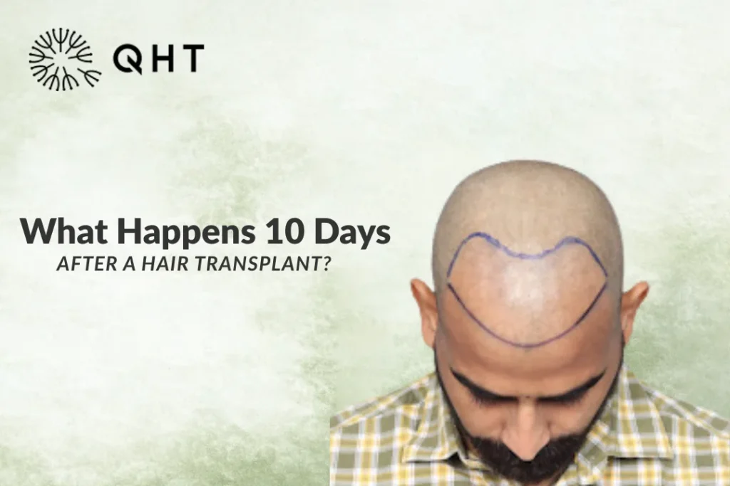 10 days after hair transplant