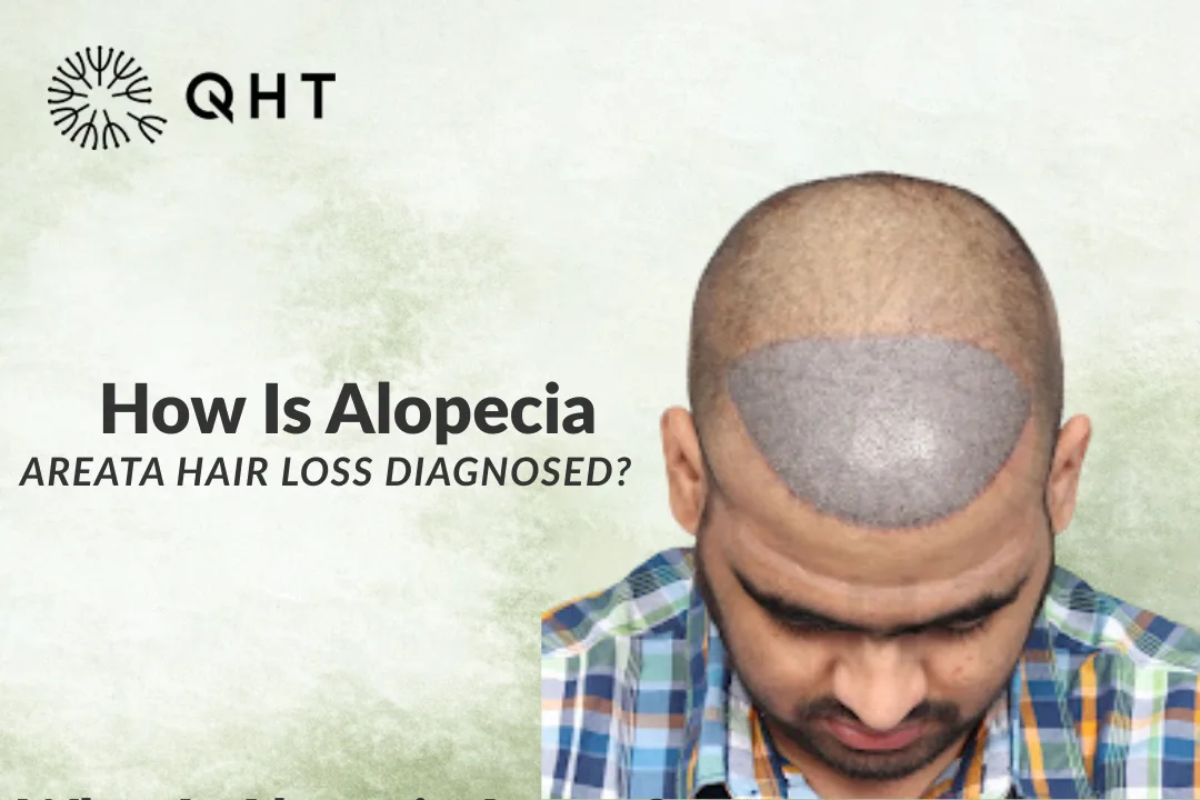 How Is Alopecia Areata Hair Loss Diagnosed?