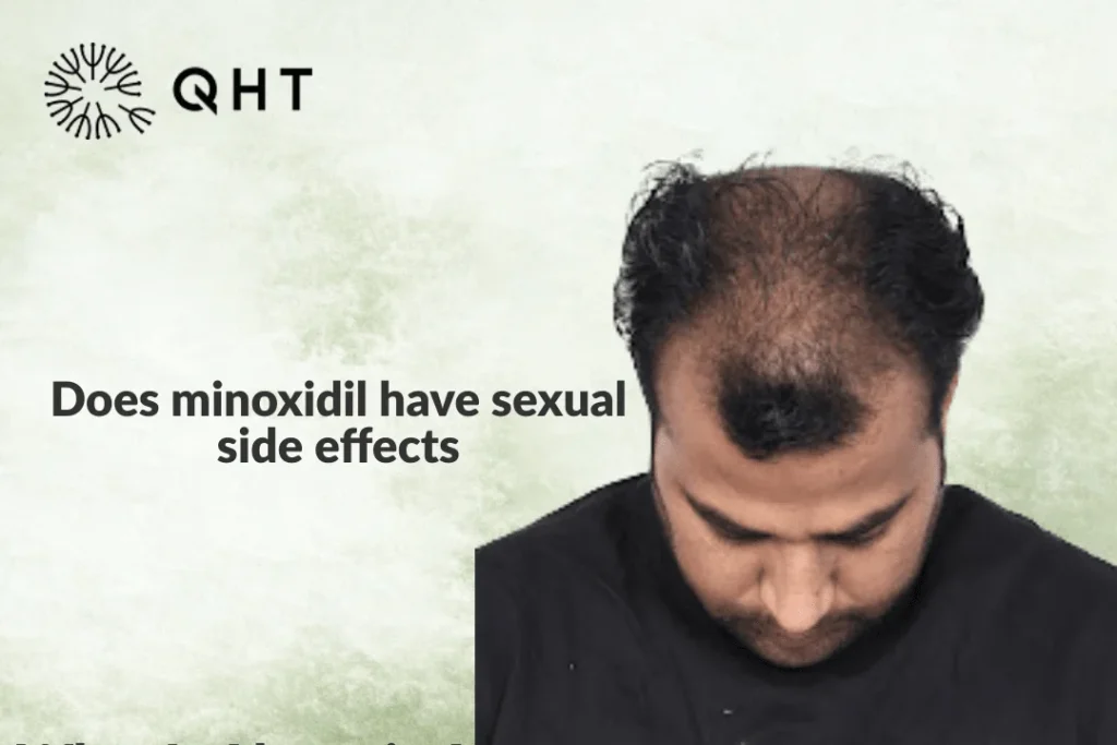 minoxidil side effects sexually