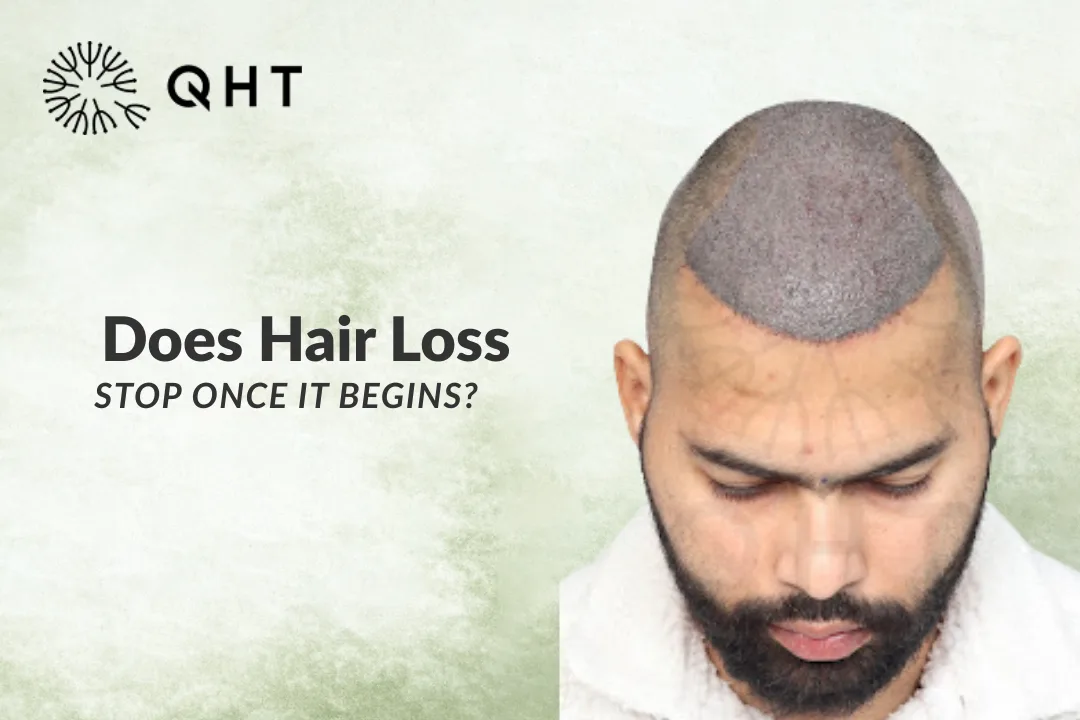 Does Hair Loss Stop Once It Begins?