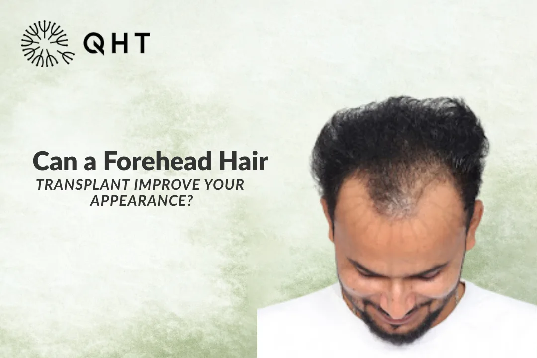 Can a Forehead Hair Transplant Improve Your Appearance?
