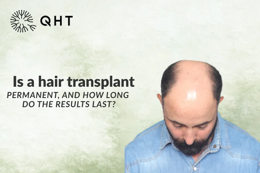 Is a hair transplant permanent and how long do the results last?