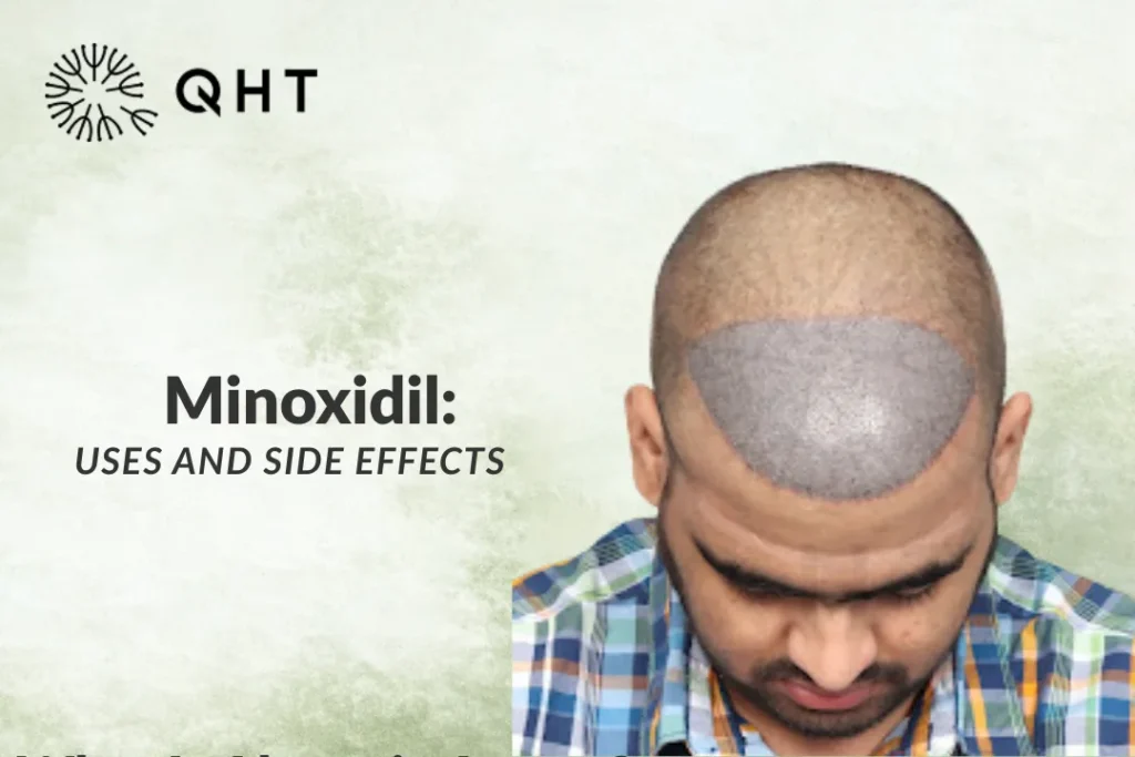 Minoxidil: Uses and Side Effects