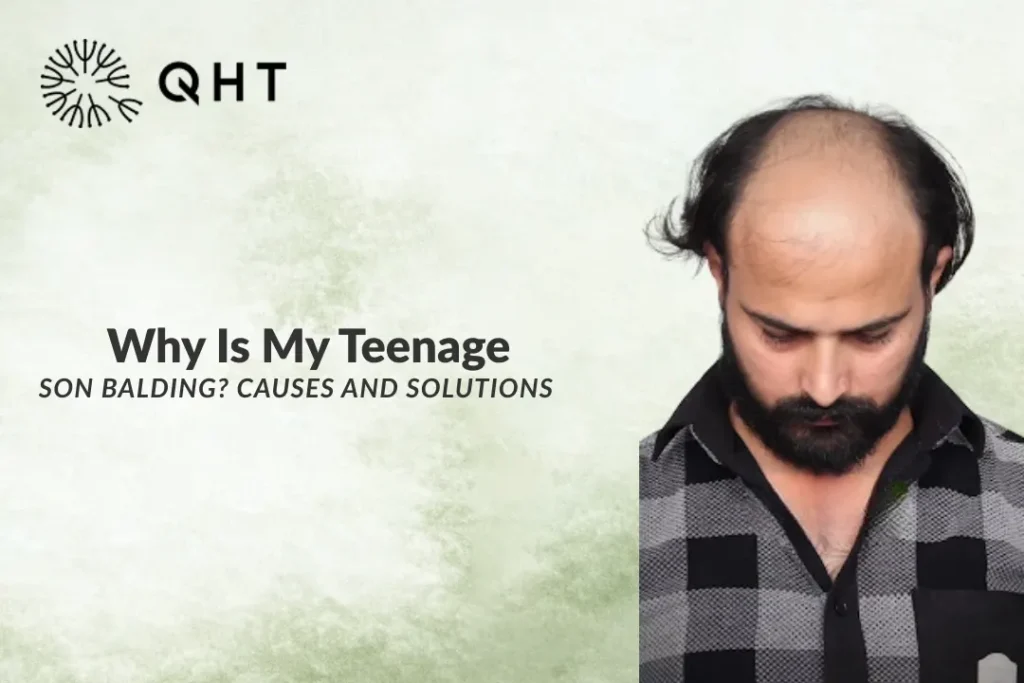 Teenage balding