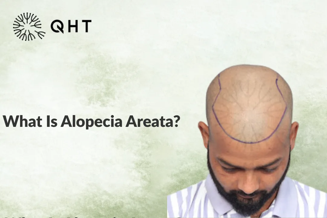 What Is Alopecia Areata?