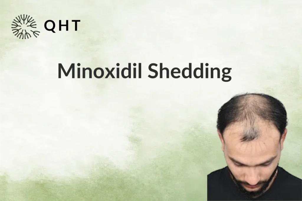 Minoxidil Shedding Phase