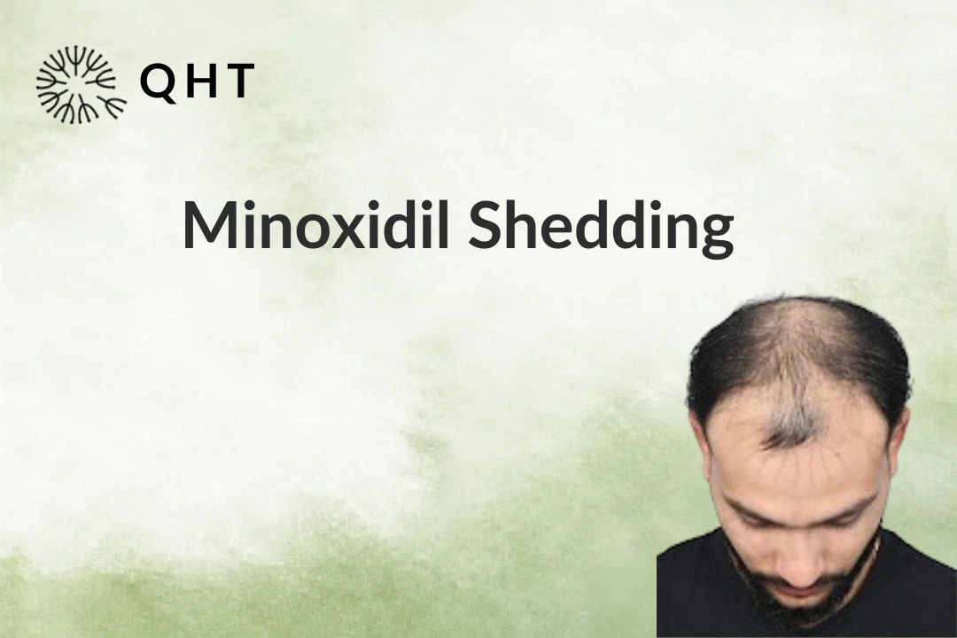 Minoxidil Shedding Phase