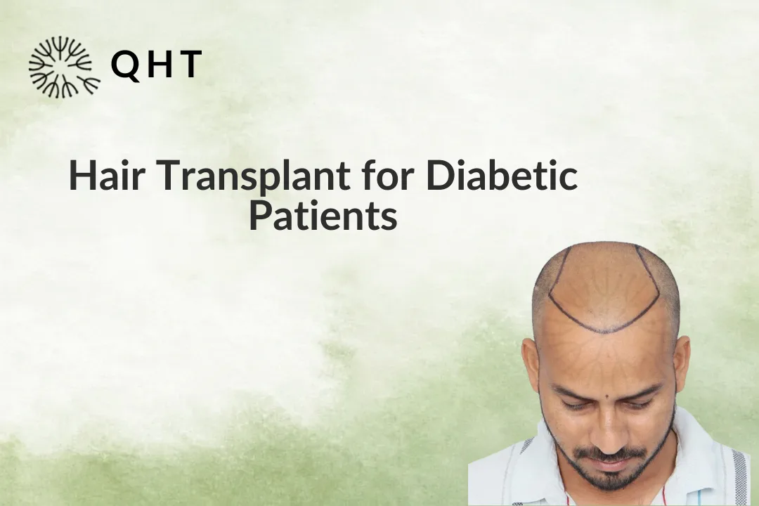 Hair Transplant for Diabetic Patients: Benefits, Risks & Recovery Guide