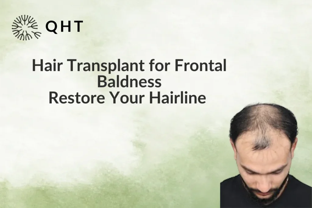 Hair transplant for frontal baldness
