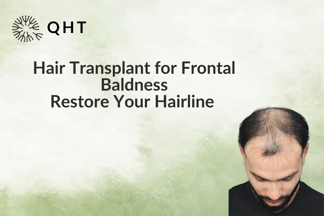 Hair Transplant for Frontal Baldness: Restore Your Hairline Naturally