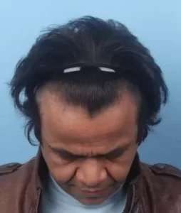 Rajpal yadav hair transplant journey